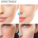 Dark Spot Remover for Face and Body: Hyperpigmentation Treatment - Natural Ingredient - Freckle/Melasma/Sun Spot/Age Spot Remover - Dark Spot Corrector Cream for Women and Men